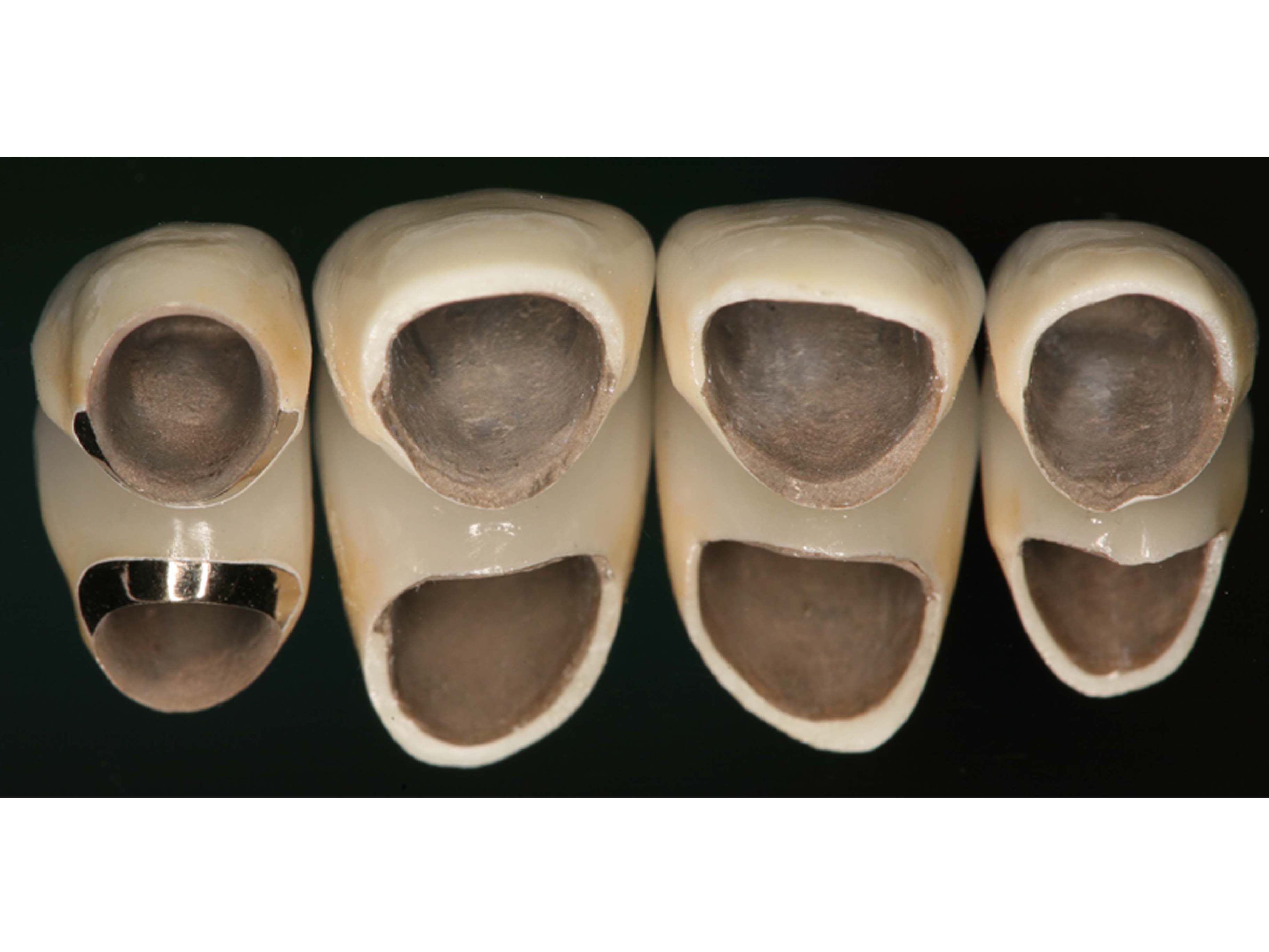 Dental Crowns and Bridges in Secunderabad